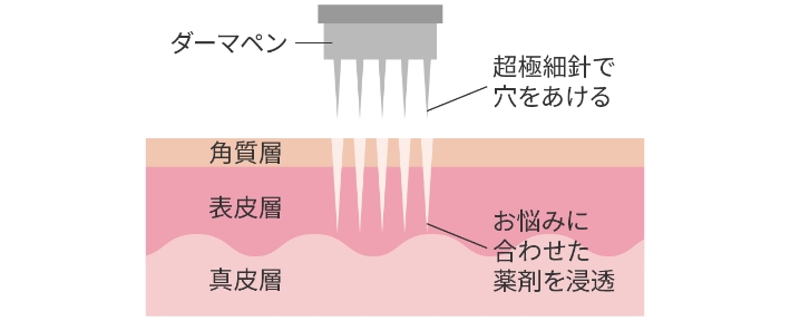 家庭用マイクロニードル装置