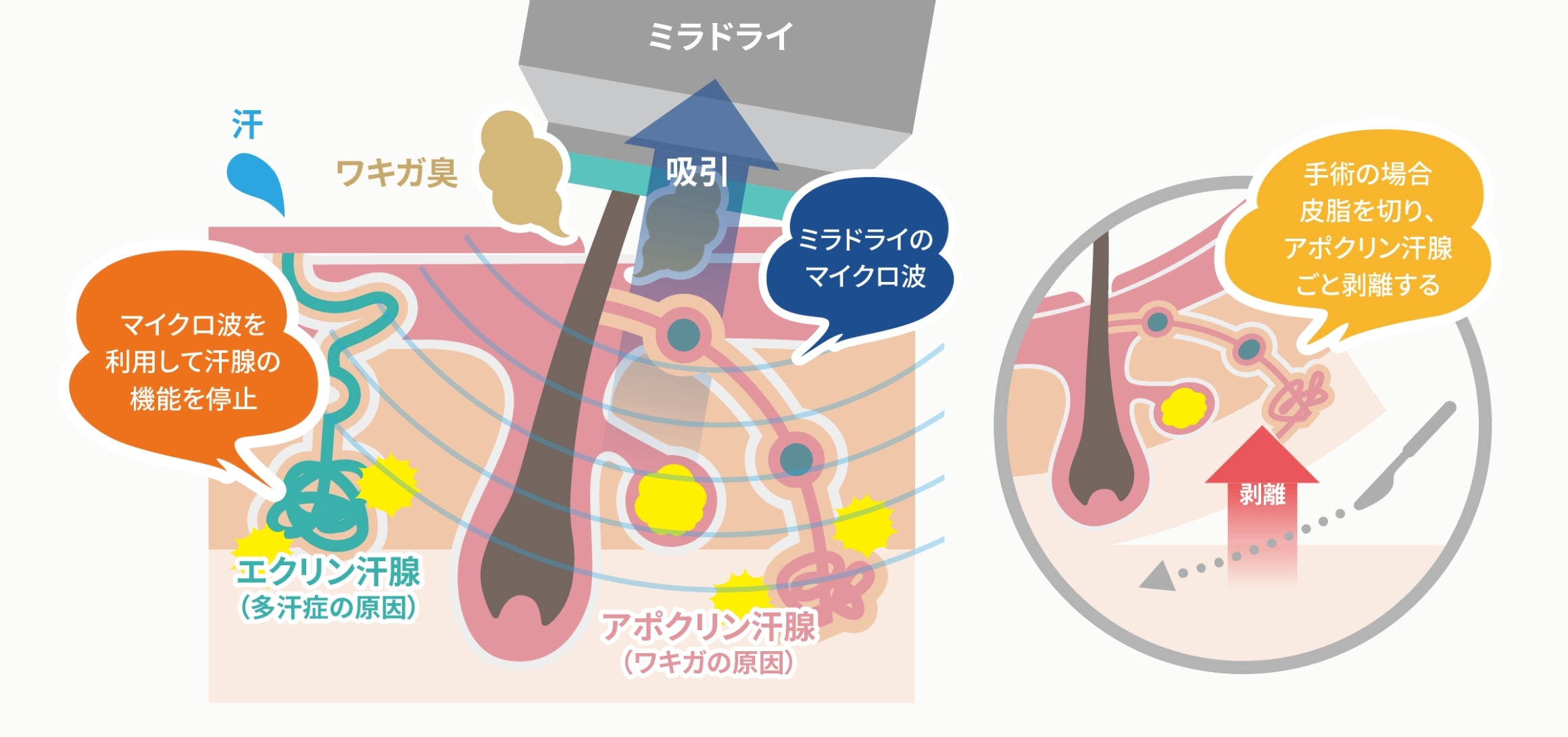 ミラドライの副作用は本当に怖い?~わきが・多汗症治療の安全性と効果を徹底解説~のサムネイル